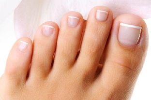 fungus of the toenails